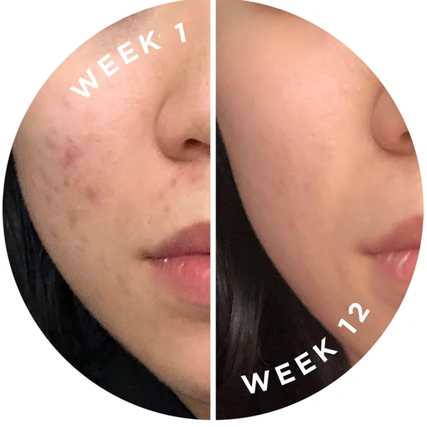 Zitsticka Skin Discipline Skin Clarifying Supplement 106g 6 Zitsticka Skin Discipline Skin Clarifying Supplement 106g - Image 4